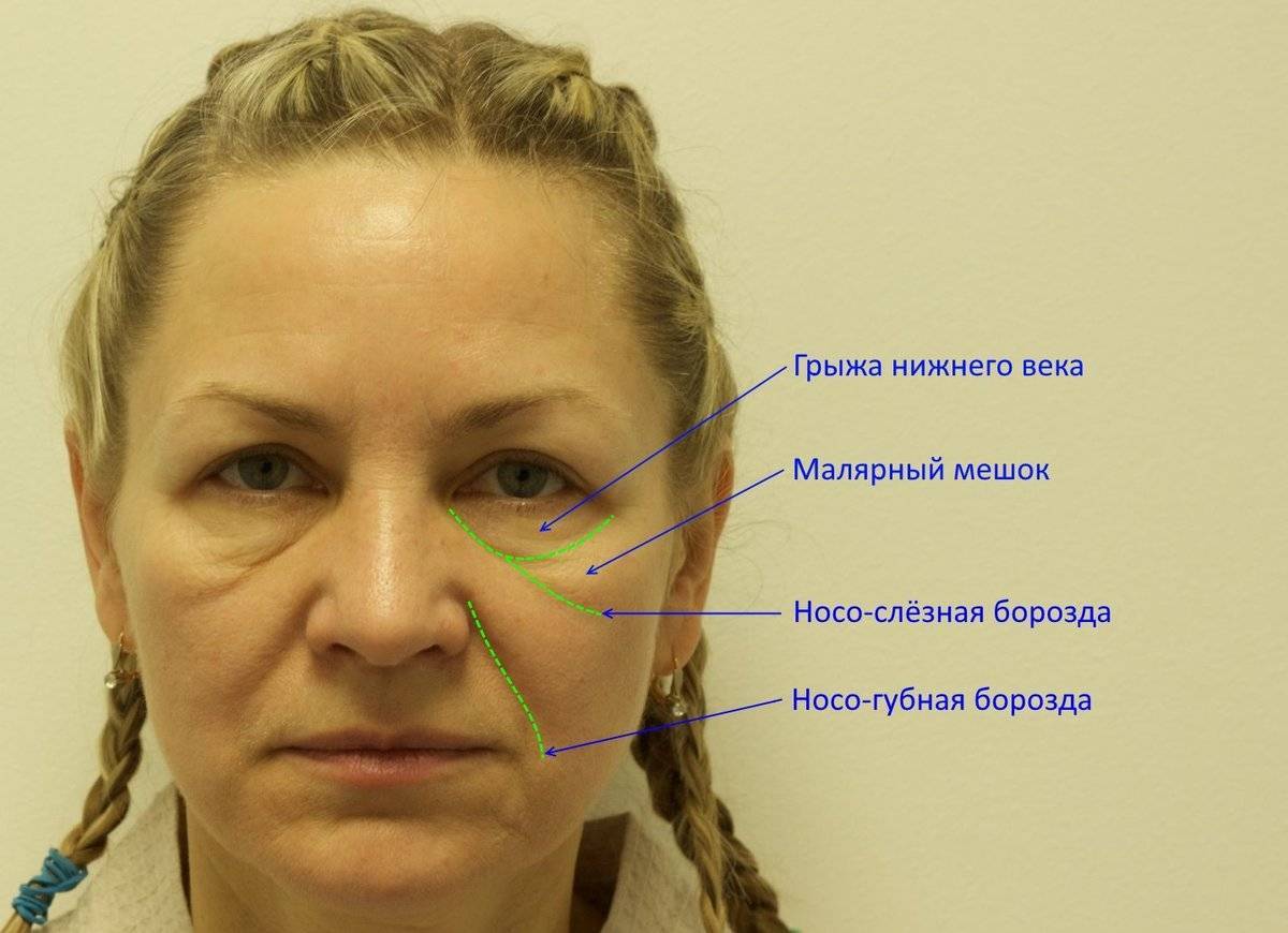 Как избавиться от усов у девушки навсегда в домашних условиях