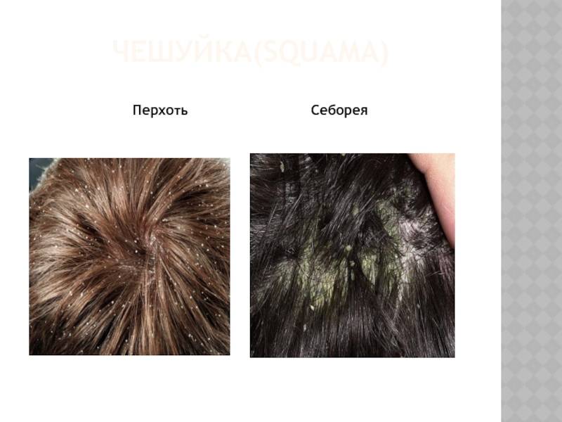 Перхоть: как от нее избавиться | портал 1nep.ru