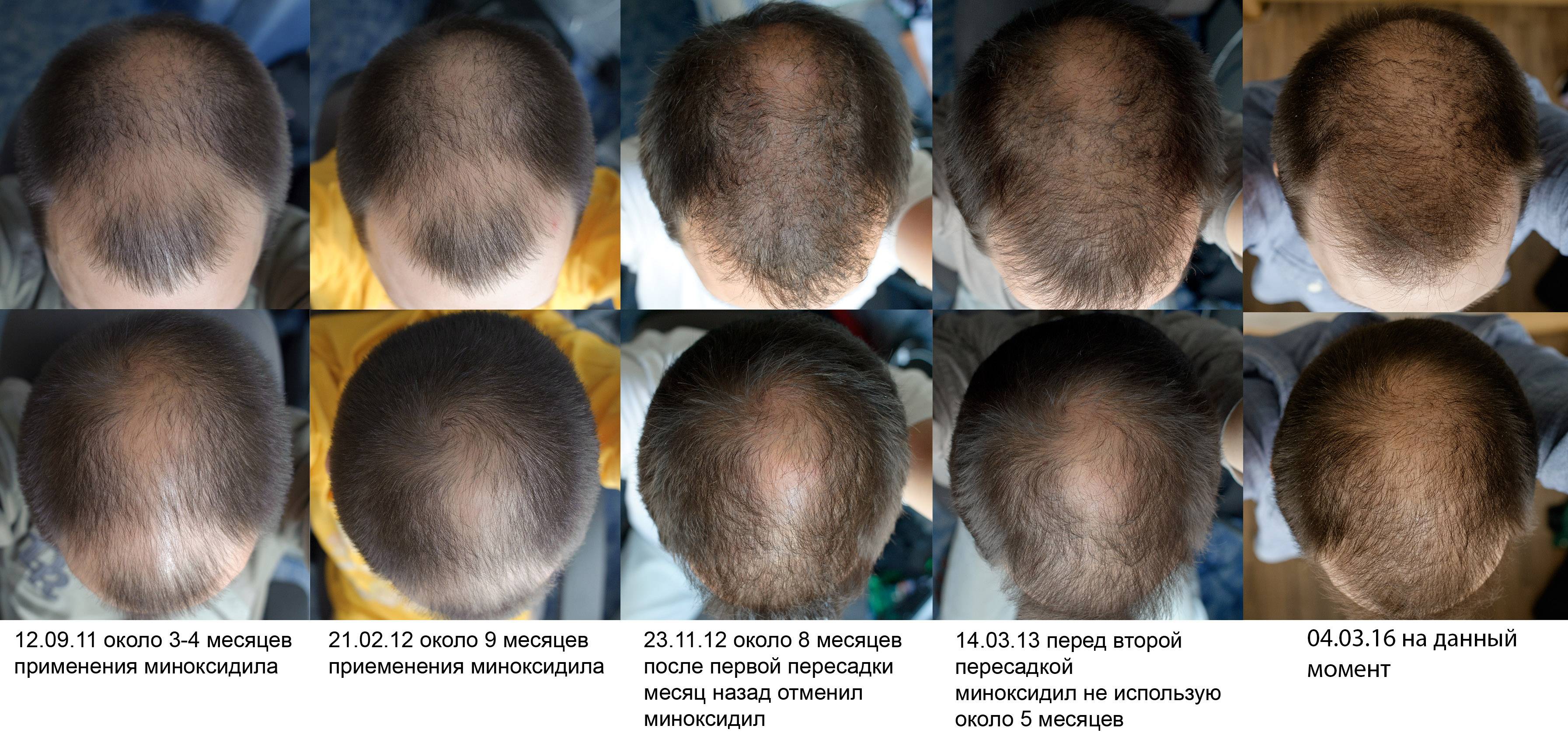 Волосы и химиотерапия: можно ли защитить от выпадения?