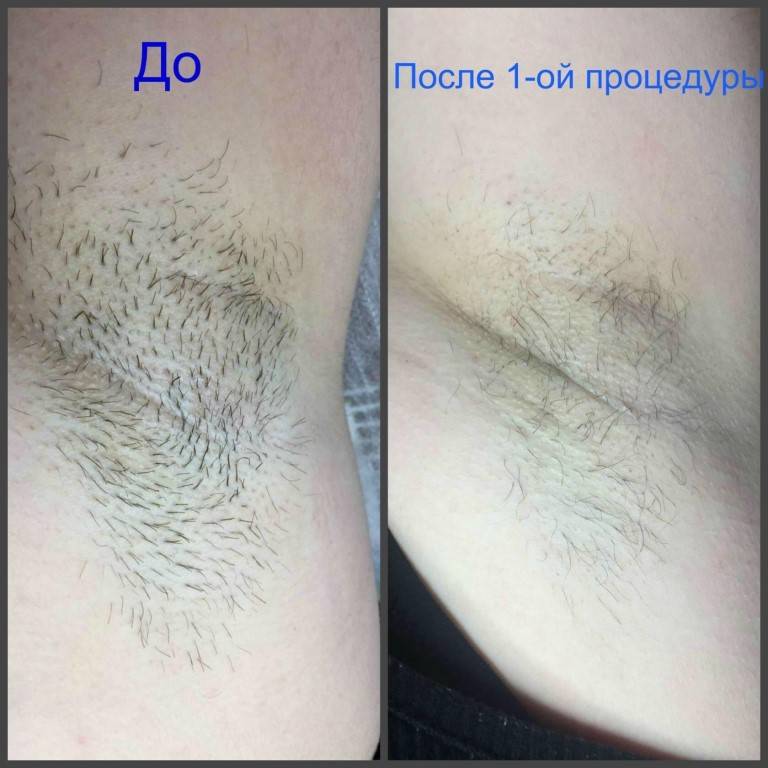 Можно ли брить руки девушкам — плюсы и минусы бритья · всё о беременности, родах, развитии ребенка, а также воспитании и уходе за ним на babyzzz.ru