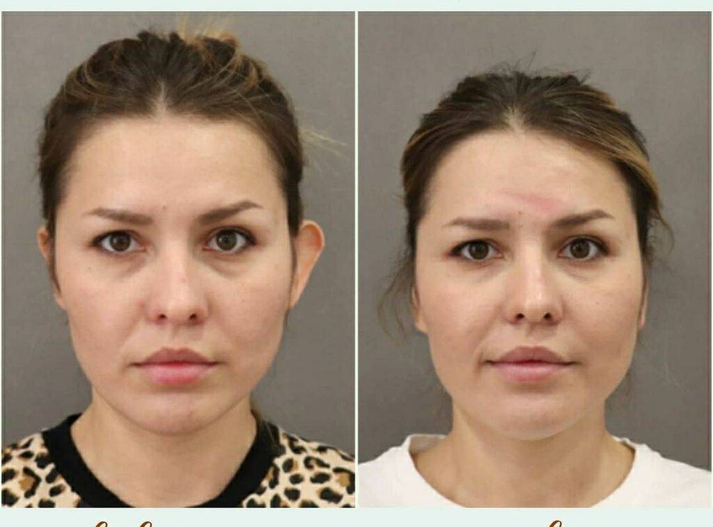 Нитевая отопластика (коррекция ушных раковин) - estetik international | aesthetic plastic surgery estetik international | aesthetic plastic surgery
